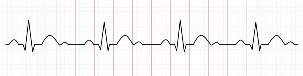 courbe cardiaque - cohérence cardiaque courbe cardiaque - cohérence cardiaque